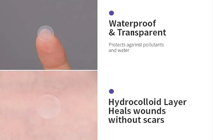 a.l.m. Magical Patch: Hydrocolloid pimple patches. These ultra thin & translucent hydrocolloid adhesive covers and absorb unwanted pimples. Parches Para Acne for skincare.
