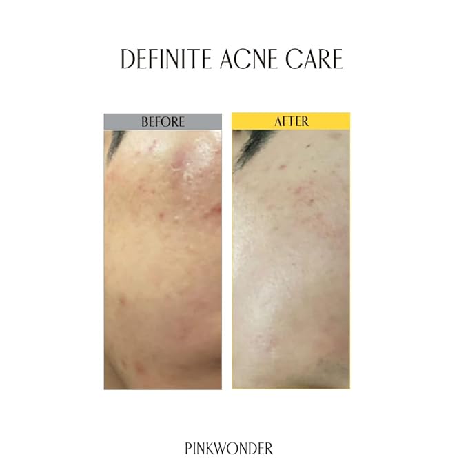 PINKWONDER Tamanu Hero Cleanser 5.07oz (150ml), Tamanu Oil and Salicylic Acid for Acne and Oily Skin, Daily Face Wash with Soothing and Moisturizing, Suitable for Sensitive Skin, Korean Skincare