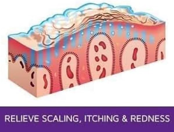 Psoriasis Exfoliating & Moisturizing Ointment – 2oz | Psoriasis Care to Restore Dry, Rough, Cracked or Scaling Skin - Shea Butter, Vitamin E, Steroid-Free | Great for Knees and Elbows