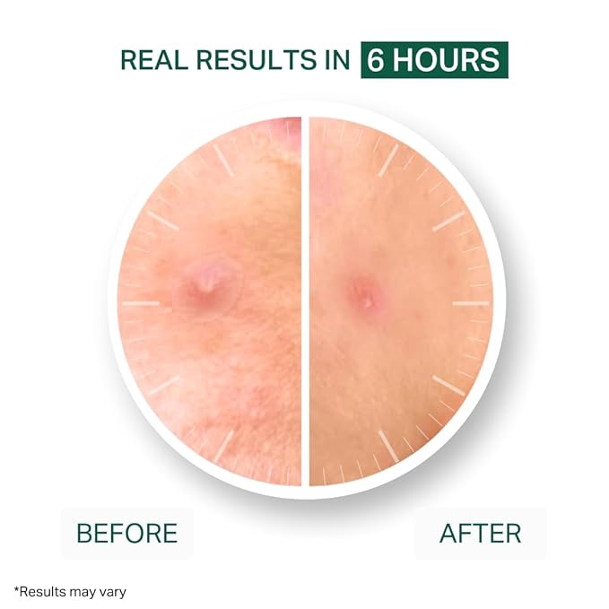 Y’OUR Improving Acne Patches: Hydrocolloid Pimple Patch for Face; Purifies & Alleviates Stubborn Blemishes, Promotes Healing, Effective Zit Treatment. Made in USA. 56 Count