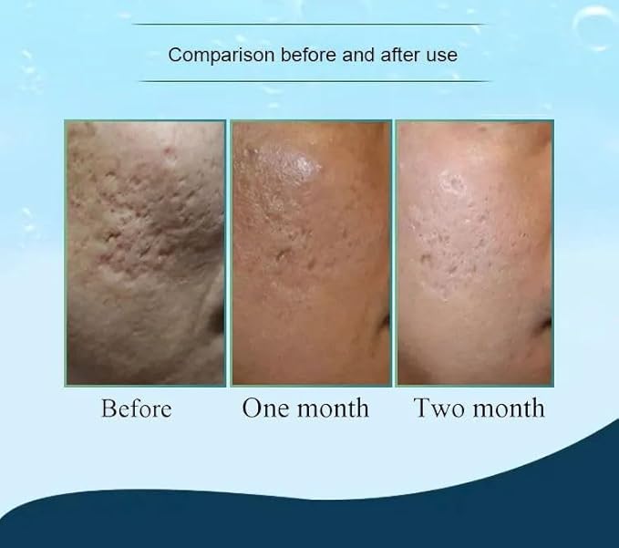 Hydra Needle 20 Titanium Serum Applicator