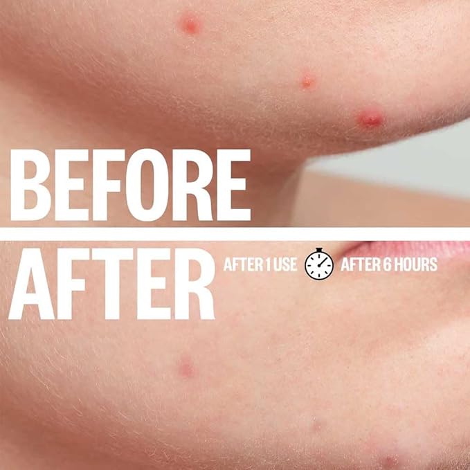 a.l.m. Magical Patch: Hydrocolloid pimple patches. These ultra thin & translucent hydrocolloid adhesive covers and absorb unwanted pimples. Parches Para Acne for skincare.