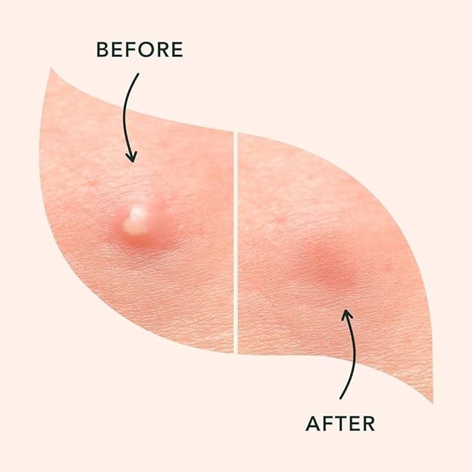 a.l.m. Magical Patch: Hydrocolloid pimple patches. These ultra thin & translucent hydrocolloid adhesive covers and absorb unwanted pimples. Parches Para Acne for skincare.