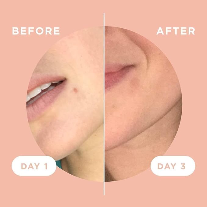 ZitSticka Killa Pimple Patches for Face - World's Most Potent Pimple Patch with Fast-Acting Microdarts - Starts Working within 6 Hours for Deep, Early-Stage Zits - Regular 28 Count with Cleana Swab