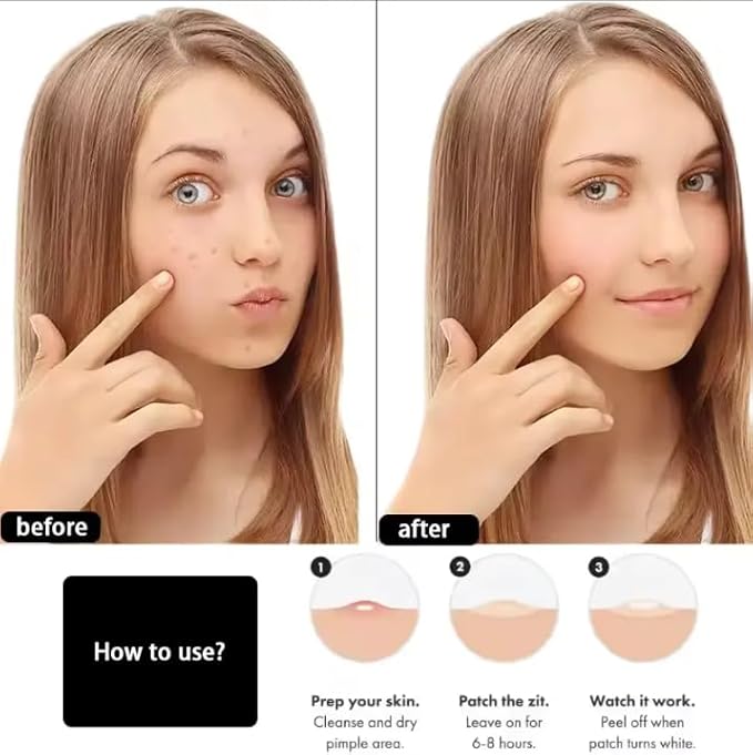 Hydrocolloid Acne Pimple Patches – Invisible Zit Stickers for Face & Skin | Blemish Spot Dots with Tea Tree Oil, Overnight Pimple Patch for Teens & Breakouts