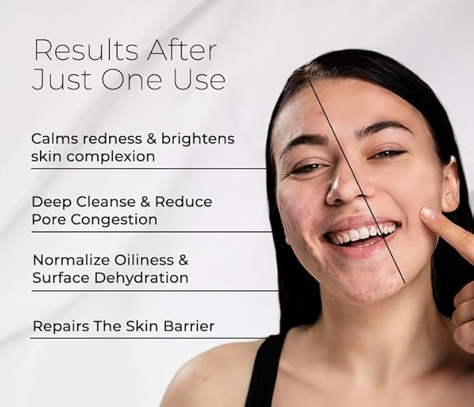 Bioactive Facial Cleanser Treatment for Oily Skin - Non-Foaming Face Wash Provides a Gentle Deep Clean and Eliminates Excess Oil (4.5 fl oz)