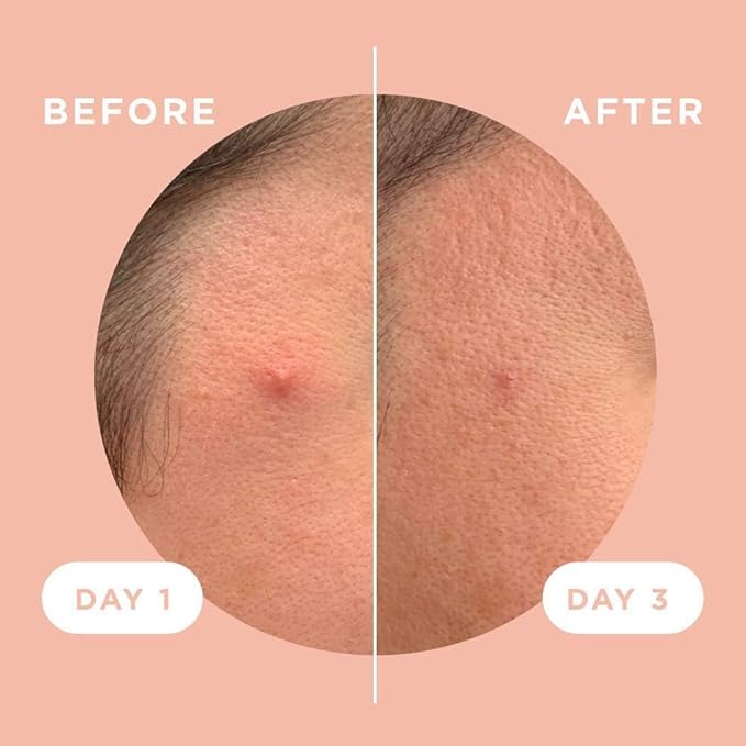 ZitSticka Killa Pimple Patches for Face - World's Most Potent Pimple Patch with Fast-Acting Microdarts - Starts Working within 6 Hours for Deep, Early-Stage Zits - Regular 28 Count with Cleana Swab