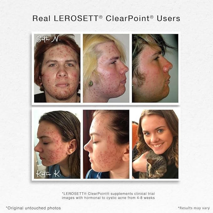 LEROSETT ClearPoint Anti Acne Pills, Natural Supplements for Hormonal & Cystic Acne Treatment for Oily Skin & Breakouts. 60 Caps