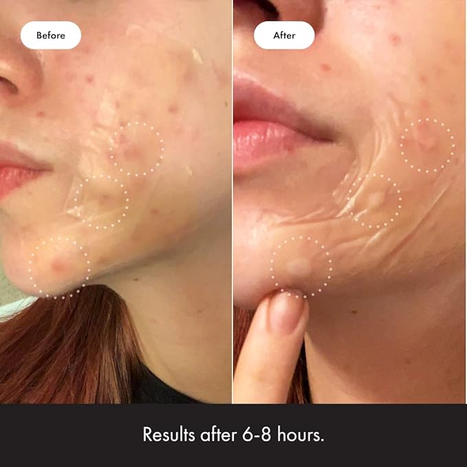 Mighty Patch Hero Cosmetics Surface Patch - Large Hydrocolloid Spot Patch for Body, Cheek, Forehead, and Chin (10 Count)