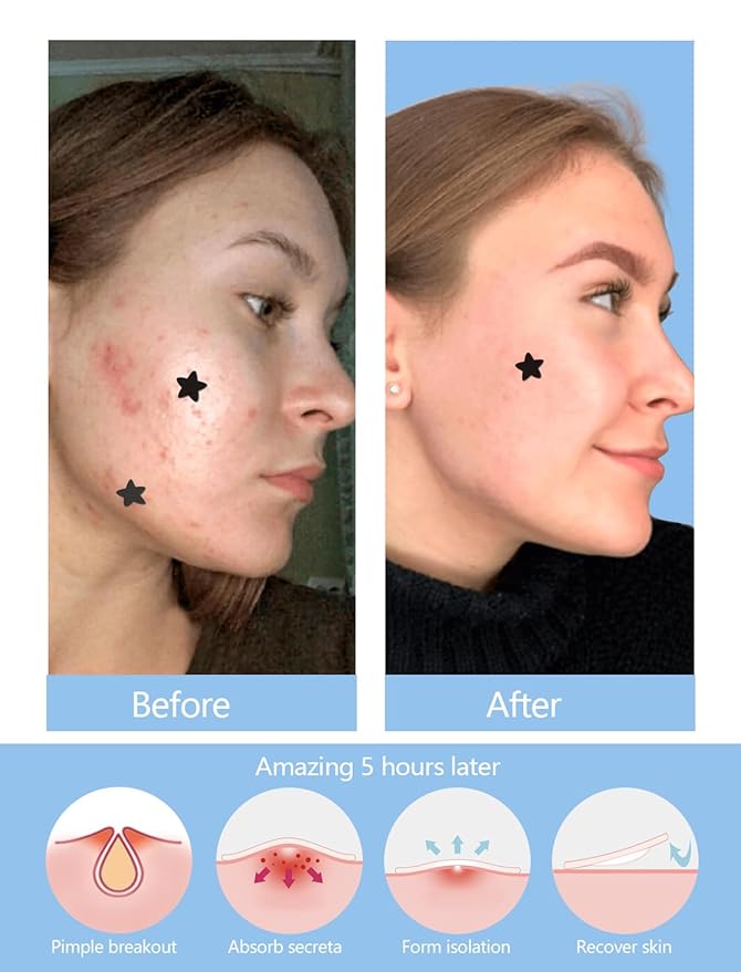 Black Star Pimple Patches for Face, 153 Counts Hydrocolloid Star Acne Patches, Cute Zit Covers for Face, Spot Stickers with Tea Tree, Salicylic Acid and Cica Oil