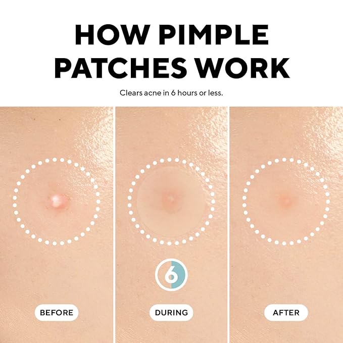 caraseoul Pimple Patches, 2 Size Hydrocolloid Acne Patch for Zits and Blemishes, Bakuchiol & Aloe Vera, Korean Skin Care, Easy to Use – Dermatology Tested