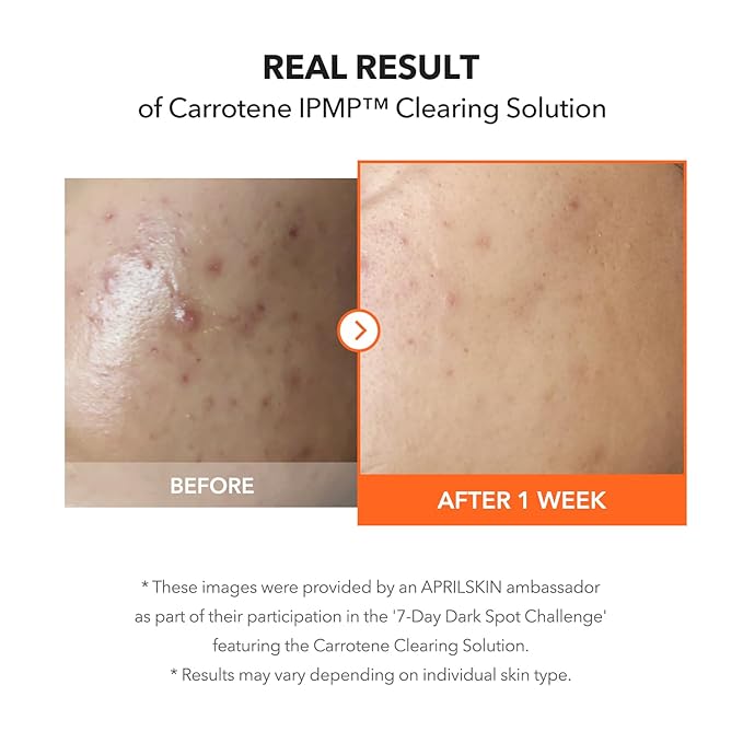 APRILSKIN Carrotene IPMP™ Clearing Solution || Quickly soothes troubled areas and helps clear blemishes | Formulated with BHA, AHA, Niacinamide & Zinc Oxide | Vegan, Cruelty-Free (0.67fl.oz.)