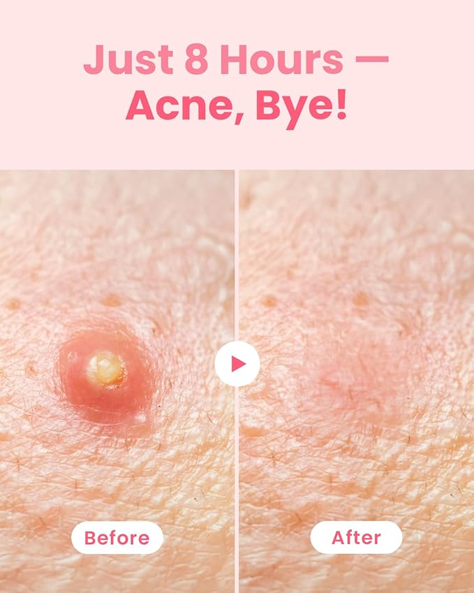 GLAM UP Hydrocolloid Blemish Pimple Zit Patches - Invisible Ultra Thin Spot Cover Stickers for Face and Skin, Strong Water-proof and Adhesive Overnight Thin & Invisible (72 Count / 2 Sizes)