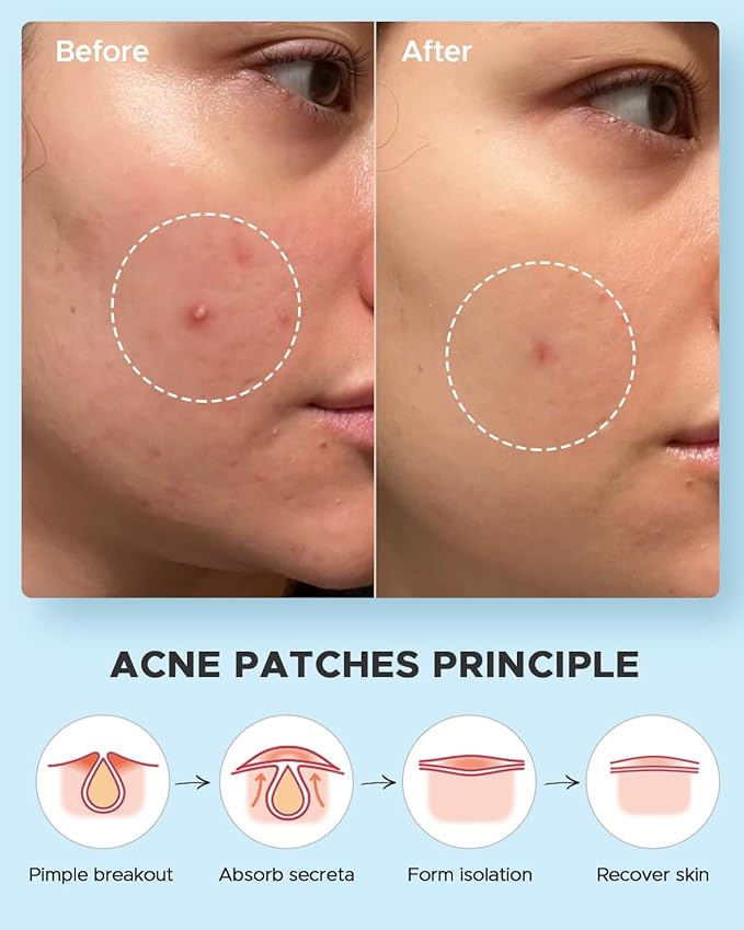 LitBear Acne Pimple Patches- Day and Night 4 Sizes 588 Dots Thin & Thick Hydrocolloid Patches with Witch Hazel, Tea Tree & Calendula Oil, Extra Adhesion for Face Zit Patch Dots