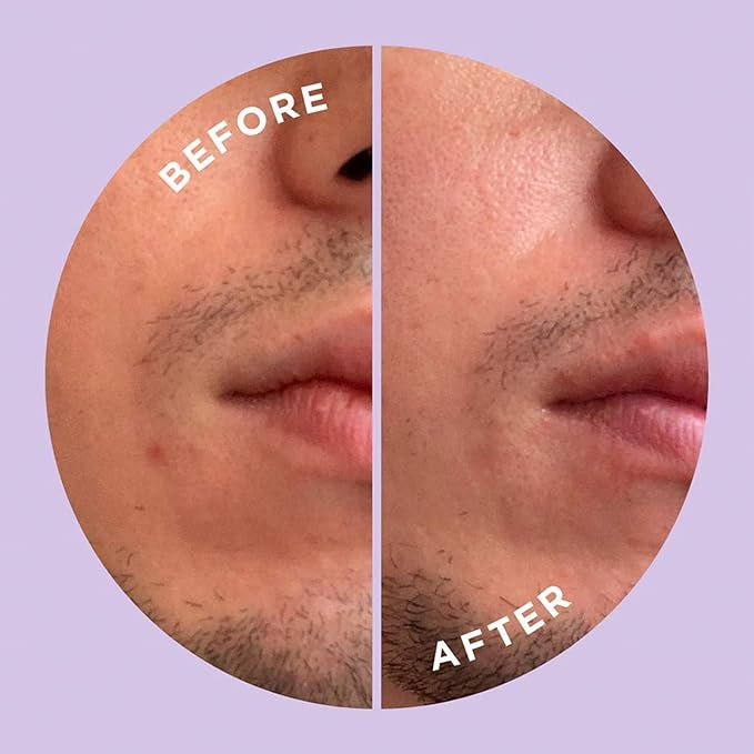 ZitSticka Hyperfade Microdart Pimple Patch, Targets Post-Zit Blemishes, Hydrates & Evens Skin Tone, With Hyaluronic Acid & Vitamin C for Clear, Smooth-Looking Skin (4 count)