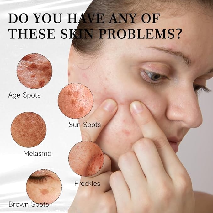 SINPIN aobenz Dark Spot Remover for Face & Body | Advanced Corrector Serum for Age, Melasma, Sun, Acne, Black Spots | Tranexamic Acid, Niacinamide Formula for Women & Men | Mild, 1.35 Fl Oz (1PCS)