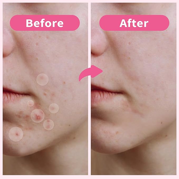 Pimple Patches for Face, 300pcs 4 Size Hydrocolloid Acne Patches for Covering Zits and Blemishes, Hydrocolloid Patch with Salicylic Acid, Tea Tree Oil and Calendula Oil