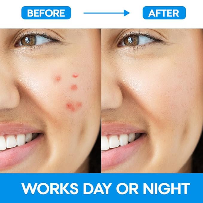 EZACNE™ Pimple Patches for Face - Thin Medical-Grade Hydrocolloid Acne Patches for Zits and Blemishes, Spot Treatment Stickers for Face and Skin, Tapered Edges to Blend Into Skin (36 Count)