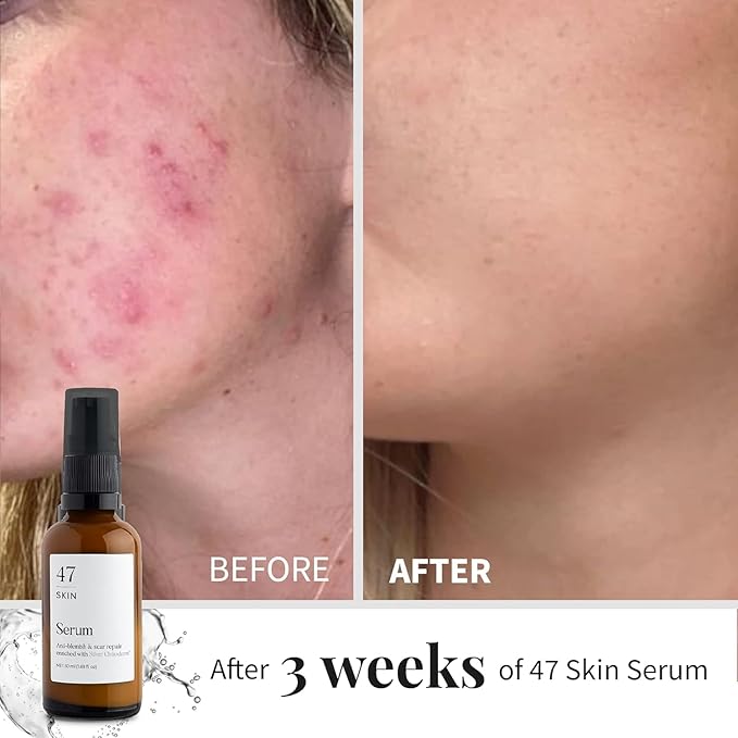 Hydrating Face Serum for Clearing Acne and Scars, Anti-Blemish & Scar Repair Serum Skincare Treatment with Silver Chitoderm Smooth Skin Moisturiser Serum for All Skin Types (1.69 oz)