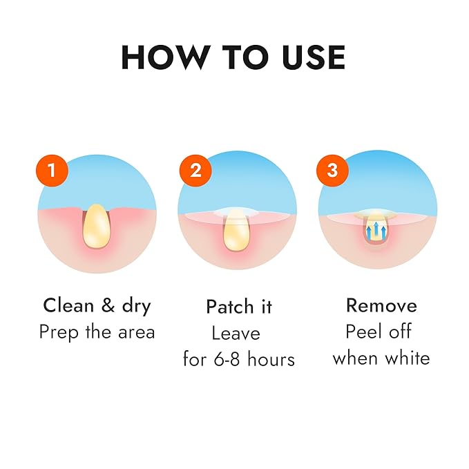 Epielle Over-Zit Acne Clear Patches 138 Count, Hydrocolloid Acne Pimple Patch for Covering Zits and Blemishes