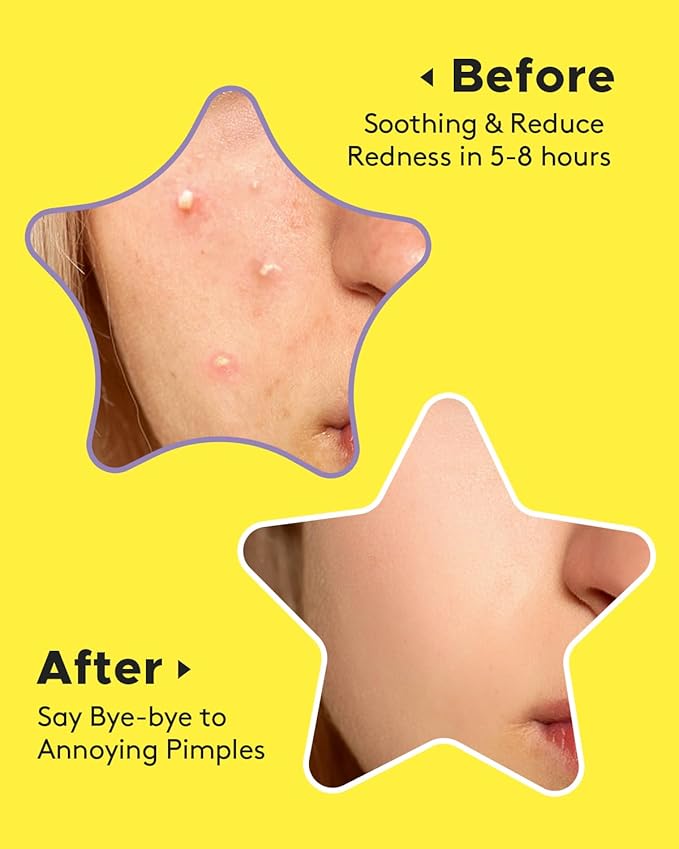 LitBear Acne Patch Pimple Patch, Colorful Star Hydrocolloid Acne Patches For Face, Cute Zit Patch Acne Sticker Spot Pimple Patches for Face, Tea Tree Oil + Centella (112 Count)