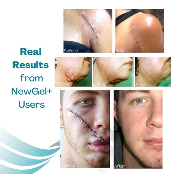 Advanced Silicone Scar Treatment Sheets for OLD, NEW Scars, Surgery, Keloids, C-Section, Burns, by NewGel Plus by MyNewGel, 1" x 6" Sheet (4 Count) - BEIGE