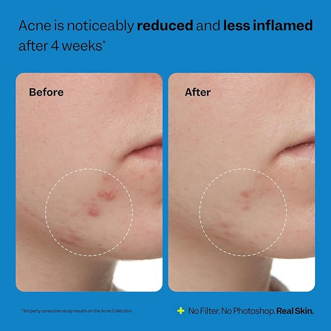 Peach Slices | Acne Exfoliating Toner | 2% Salicylic Acid | AHA+BHA Exfoliation | Facial Cleanser | Calms & Soothes | Prevents Breakouts | Alcohol & Sulfate Free | Skin Care for Women & Men | 4 Oz