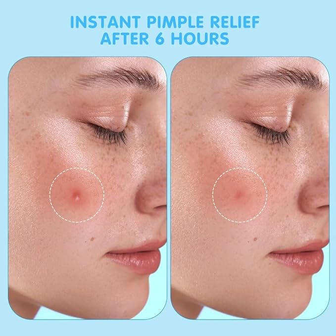 AUSLKA Pimple Patches for Face (150 Patches),Hydrocolloid Blemish Patches,Invisible Spot Cover for Face and Skin - with Temporary Mirror