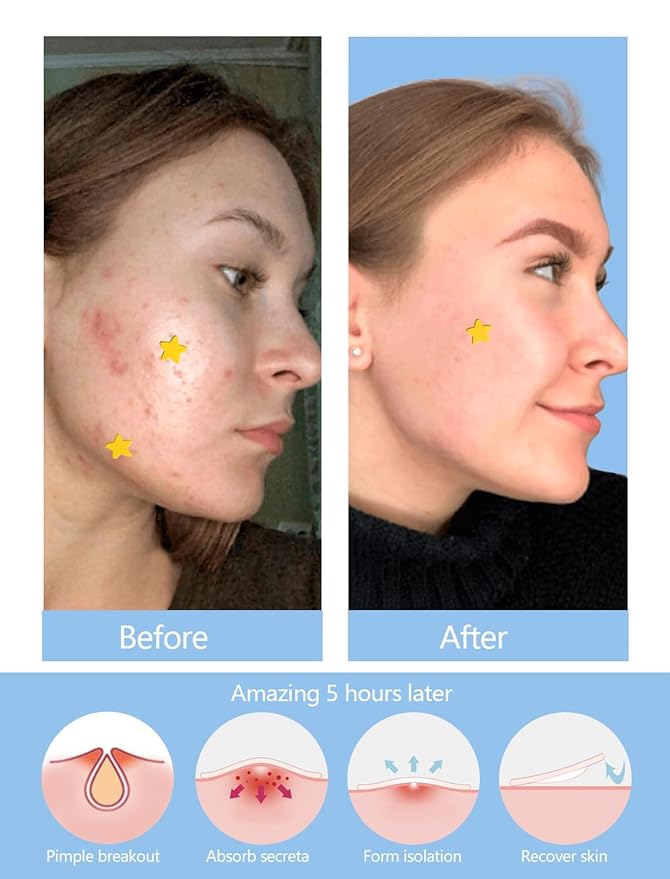 Yellow Star Pimple Patches for Face, 153 Count Hydrocolloid Star Acne Patches Invisible, Cute Zit Covers for Face, Spot Stickers with Tea Tree, Salicylic Acid and Cica Oil