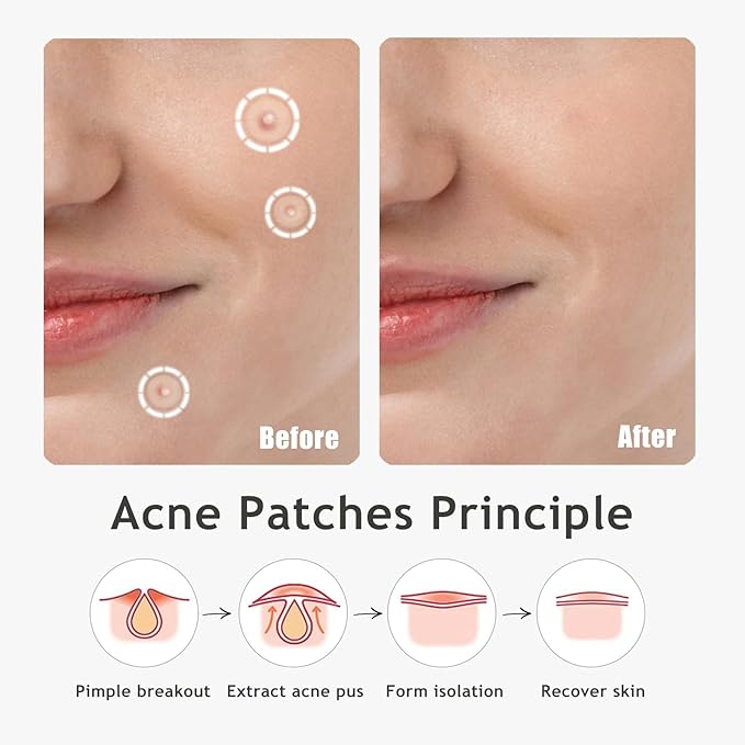 Ultra Pimple Patches - Hydrocolloid Acne Patch for Covering Zits and Blemishes Breakouts Spot Acne Dots Stickers for Face and Skin (48 counts) Day and Night Use