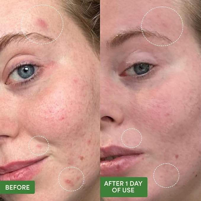 Sand & Sky Oil Control Dual Action Hydrocolloid Pimple Patches with Salicylic Acid & Centella - Blemish Spot Formula, 75 Count, For Whiteheads & Red Pimples