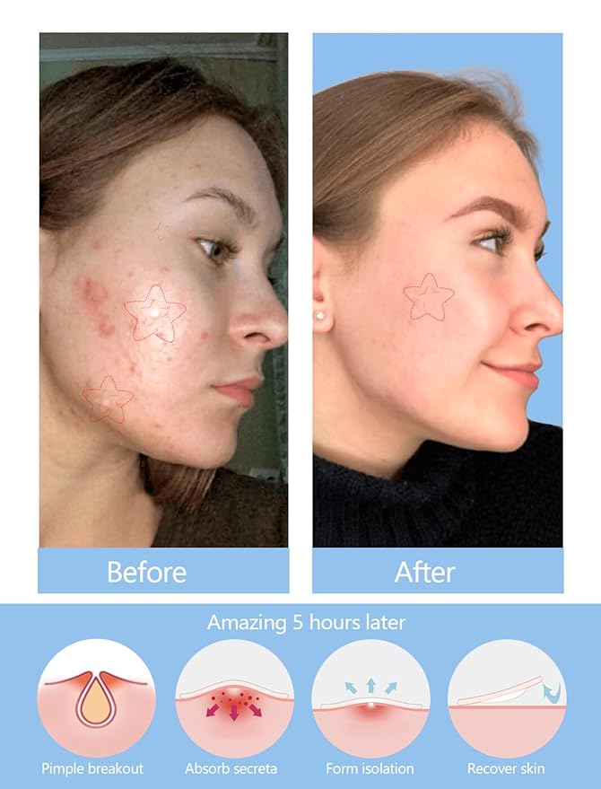 Clear Star Pimple Patches for Face, 153 Count Hydrocolloid Star Acne Patches Invisible, Cute Zit Covers for Face, Spot Stickers with Tea Tree, Salicylic Acid and Cica Oil