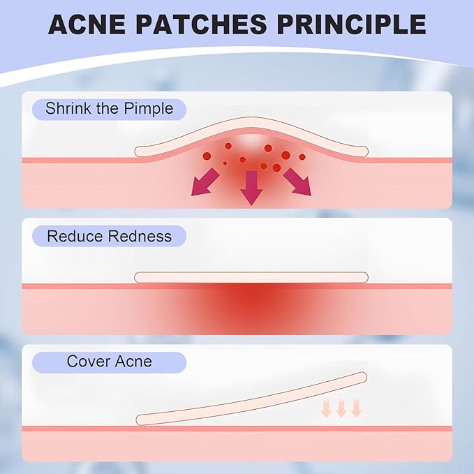 Pimple Patches for Face, Hydrocolloid Pimple Acne Patch for Covering Zits and Blemishes, Spot Stickers for Facial Skin Care (48 Count)