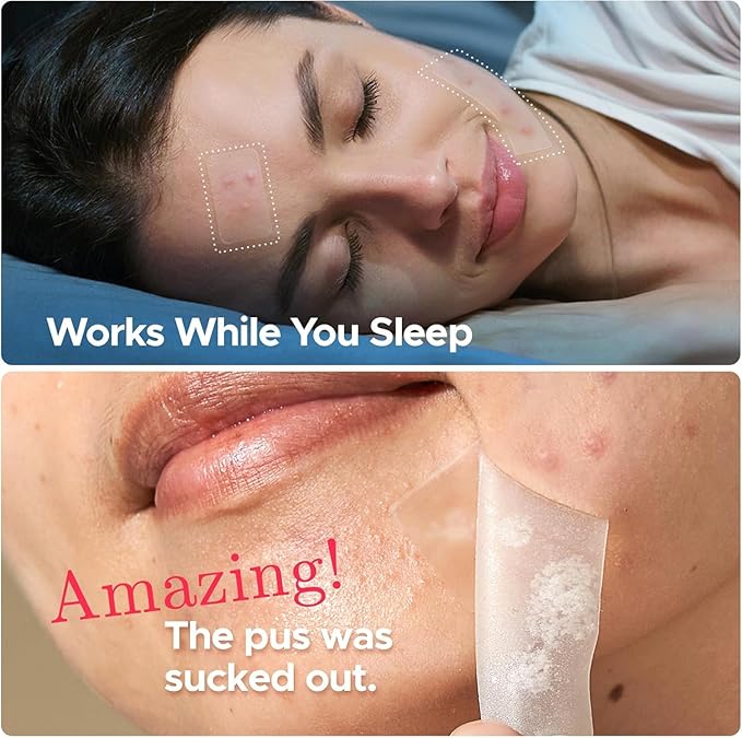 LitBear Large Pimple Patches, 5 Sizes 156 Patches Big Acne Patch, 60 XL Hydrocolloid Patch for Full Face, Forehead, Chin, Nose, Body, Back, Neck & Chest, Stirp, Square Large Hydrocolloid Bandages