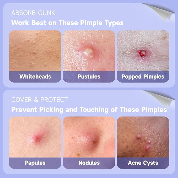 Ultra Pimple Patch Variety Pack Hydrocolloid Acne Pimple Patches with Salicylic Acid for Covering Small & Large Zits and Blemishes, Spot Stickers for Face and Skin (36 Counts)