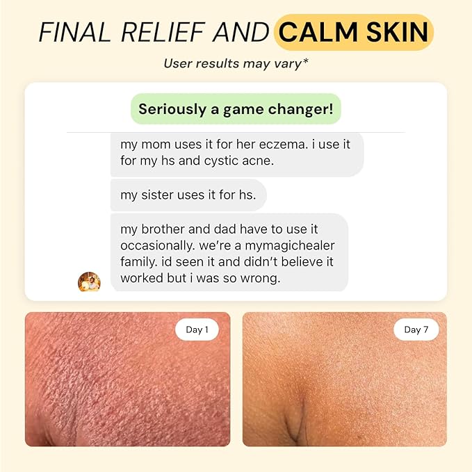 Universal Flare Care | Essential Oil Free | Relief for 100+ Skin Issues | Eczema, Dermatitis, Psoriasis, Rashes, Baby's Skin Issues, Hidradenitis, Chafing, Sores, Wounds | With Propolis & Egg Yolk 4oz