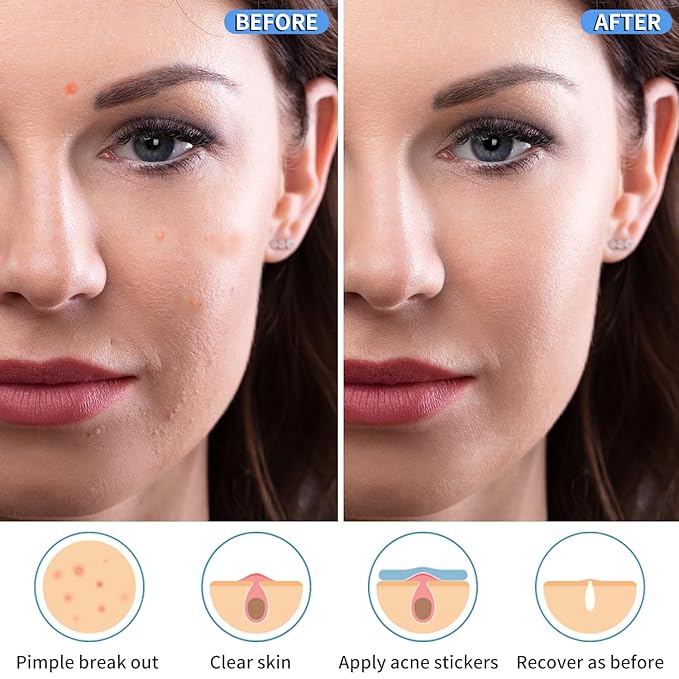 288 Counts Pimple Patches for Face, Hydrocolloid Acne Patches for Covering Zits and Blemishes, 2 Sizes of Ultra-Thin Spot Patch for All Skin Types