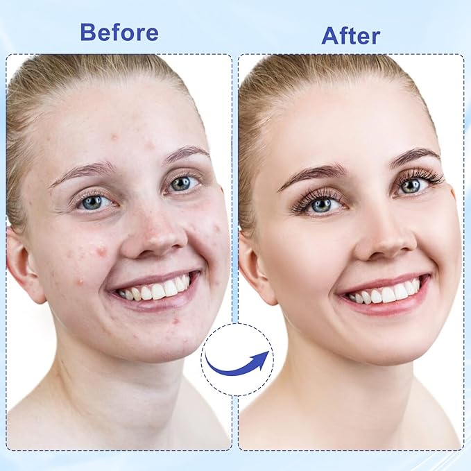 Pimple Patches for Face, 288 Hydrocolloid Acne Patches, Cute Round Shape Zit Covers, Patches for Covering Zits, Colorful Spot Stickers with Tea Tree, Salicylic Acid & Cica Oil