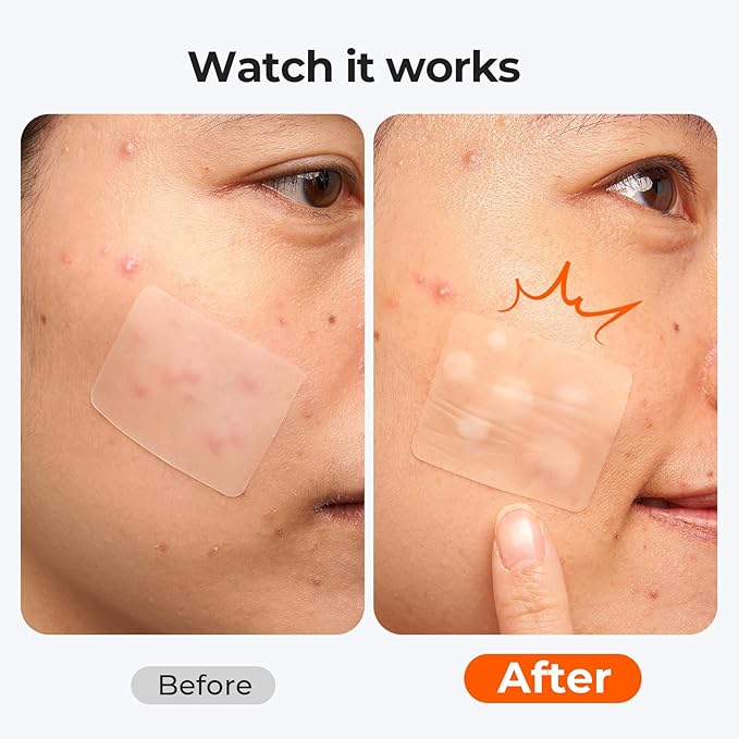 TKTK Large Pimple Patches (5 Sizes, 92 Patches), Hydrocolloid Acne Patches, XL Zit Patches for Face, Forehead, Chin, Nose, Body, Back, Chest, Rectangular, Square, and Dot Hydrocolloid Bandages