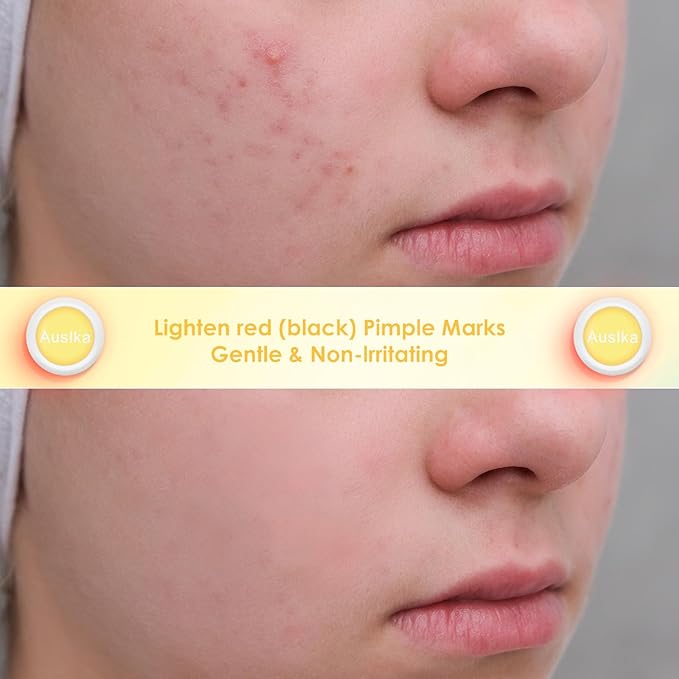 AUSLKA Light Therapy Pimple Patch, LED Red Light Hydrocolloid Zit Patches, Spot Dots for Blemishe, 6-Packs, Use 6-8 hours (Yellow, Reduces Red&Black Pimple Marks)