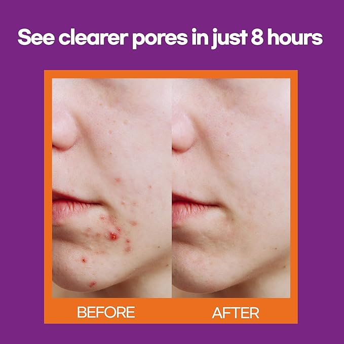 Epielle Acne Patch Shapes Edition, Acne Patches with Hydrocolloid Dressing, Fun for Parties, Sleepovers, Girls' Nights, Halloween Parties, Girls' Gift (Halloween Patch, 75ct)