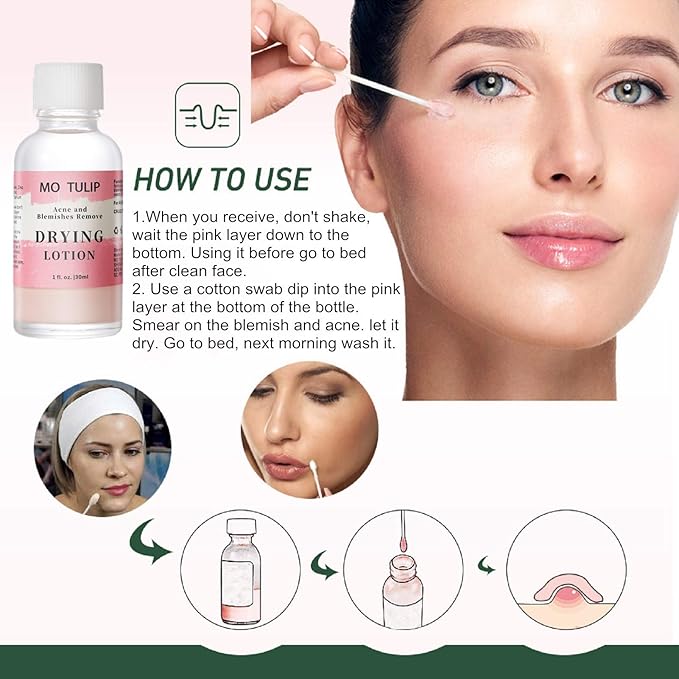 MO TULIP Acne Drying Lotion, Overnight Acne Acid and Acne Spot Treatment for Face and Body, Pimple Lotion Spot Treatment, Dry Out Pimples, Blemishes, and Clean pores (1OZ)