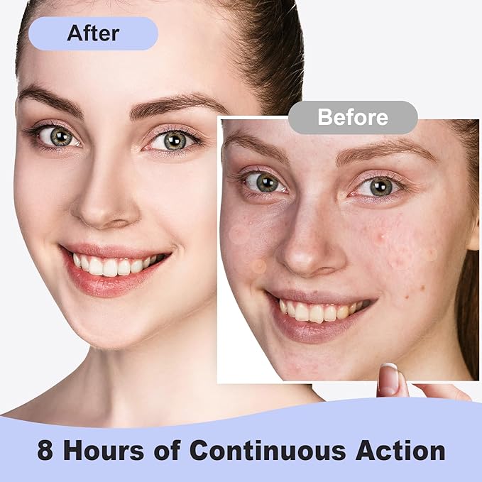 Pimple Patches for Face, Hydrocolloid Pimple Acne Patch for Covering Zits and Blemishes, Spot Stickers for Facial Skin Care (48 Count)