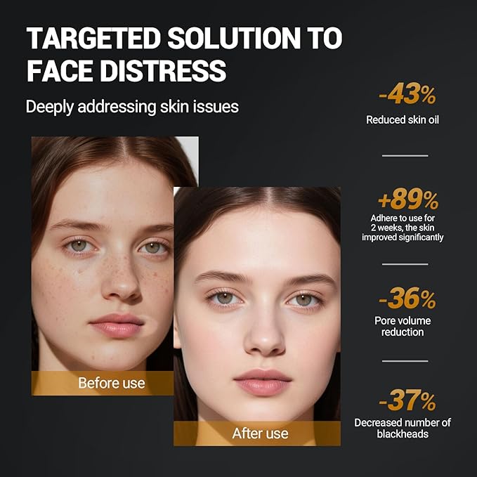 Purifying Kaolin Face Mask - Blackhead Remover and Oil Control for Sensitive/Oily/Dry Skin | Deep Recovery Clay Facial Mask with Bentonite | Detox Scrub and Pore Cleaner, 10.5oz/300g