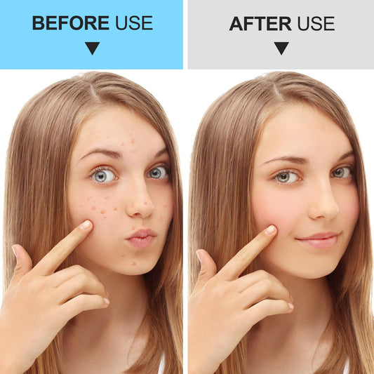 Pimple Popper Tool Kit Blackhead Remover Tools (5 Piece Kit), Professional Stainless Black Head Remover for face, Risk Free Treatment Pimple Extractor with Tweezers