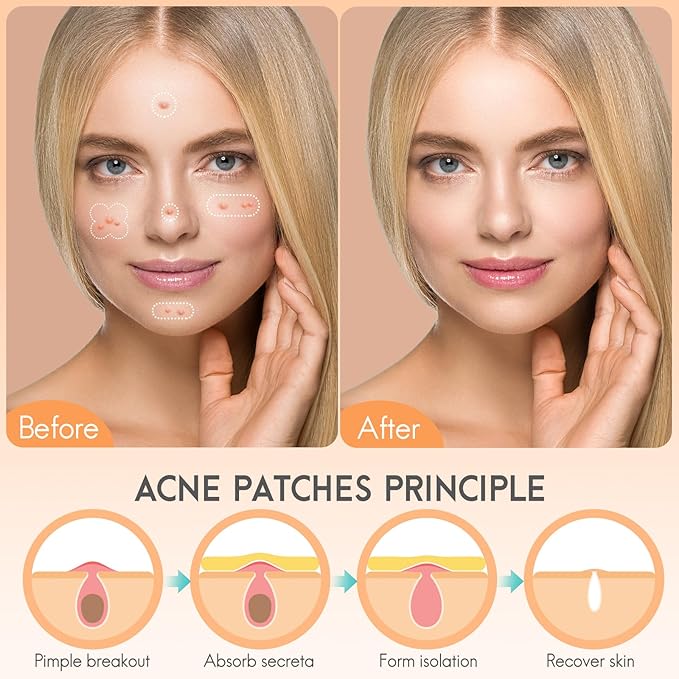 Acne hydrocolloid Patches, 4 sizes and 3 shapes with 182pcs, The innovative size L suitable face, body, nose, Pimple, Acne blemishes, with Salicylic Acid, Tea Tree Oil, Centella Asiatica