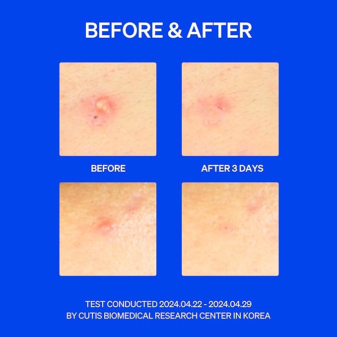 Right Away Thincognito Invisible Spot Patch - Absorbing Hydrocolloid Pimple Patch for Face, Blemishes, Zits, Acne, Breakouts Spot Treatment for Skin Care, 2 Sizes (42 Count)