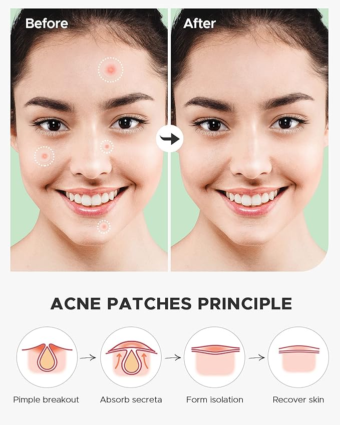 Acne Pimple Patch (180 Counts 4 Sizes), FSA Eligible Invisible Hydrocolloid Acne Patch with Tea Tree Oil & Calendula Oil, Acne Spot Patch Zit Patches for Face