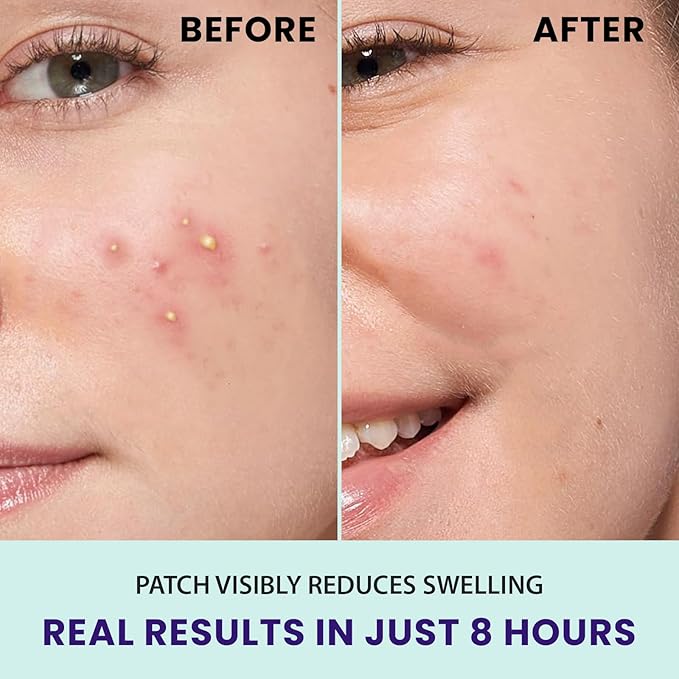 Pimple Patches for face and body | 36 Count (12mm), Invisible Hydrocolloid Acne patches – Face Stickers for Zits, dark spot , Blemishes, Pore strips, Forehead pimple patch , Invisible spot cover