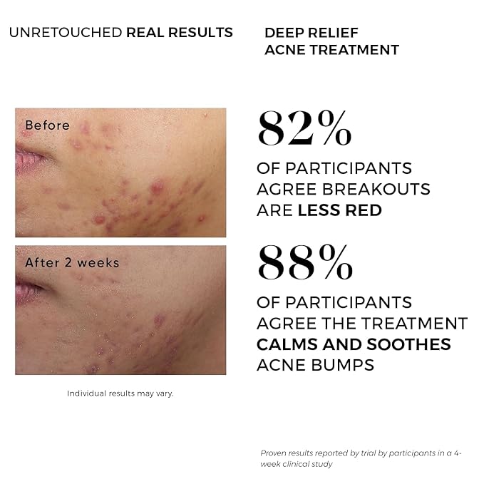 Acne Treatment Pads- Eliminates Cystic Breakouts, Oily Skin & Clogged Pores. Clear Pimple, Whitehead, Blackhead, Dark Spots & Improve Skin Texture.
